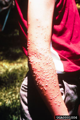 Red imported fire ant stings